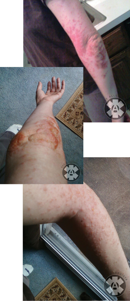 eczema-the-allergista