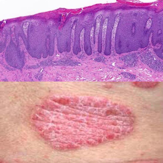 Psoriasis Overview
