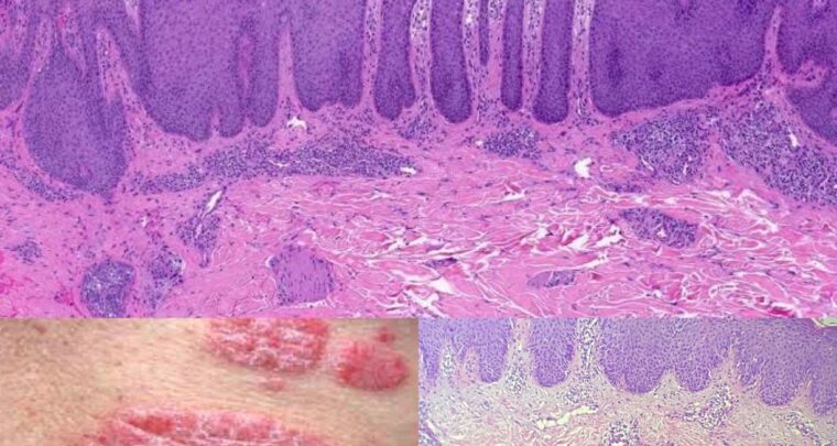 Psoriasis Overview